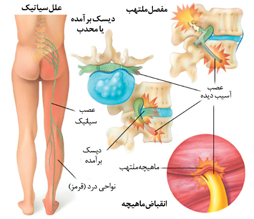 درمان سیاتیک درمان سیاتیک