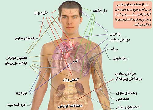 تاریخچه ی: آبسه ریه