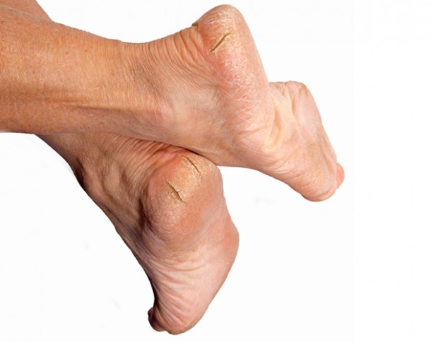 پینه پوست