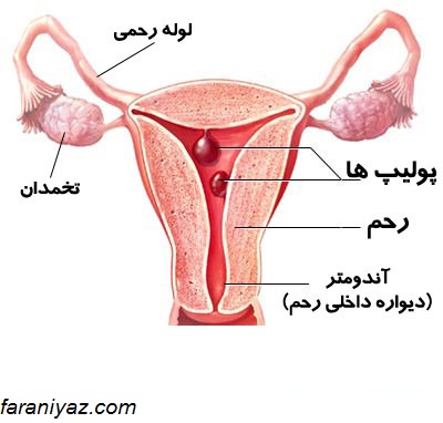 پولیپ رحمی چیست؟