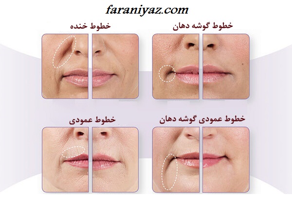 انواع ماسک ضد چروک