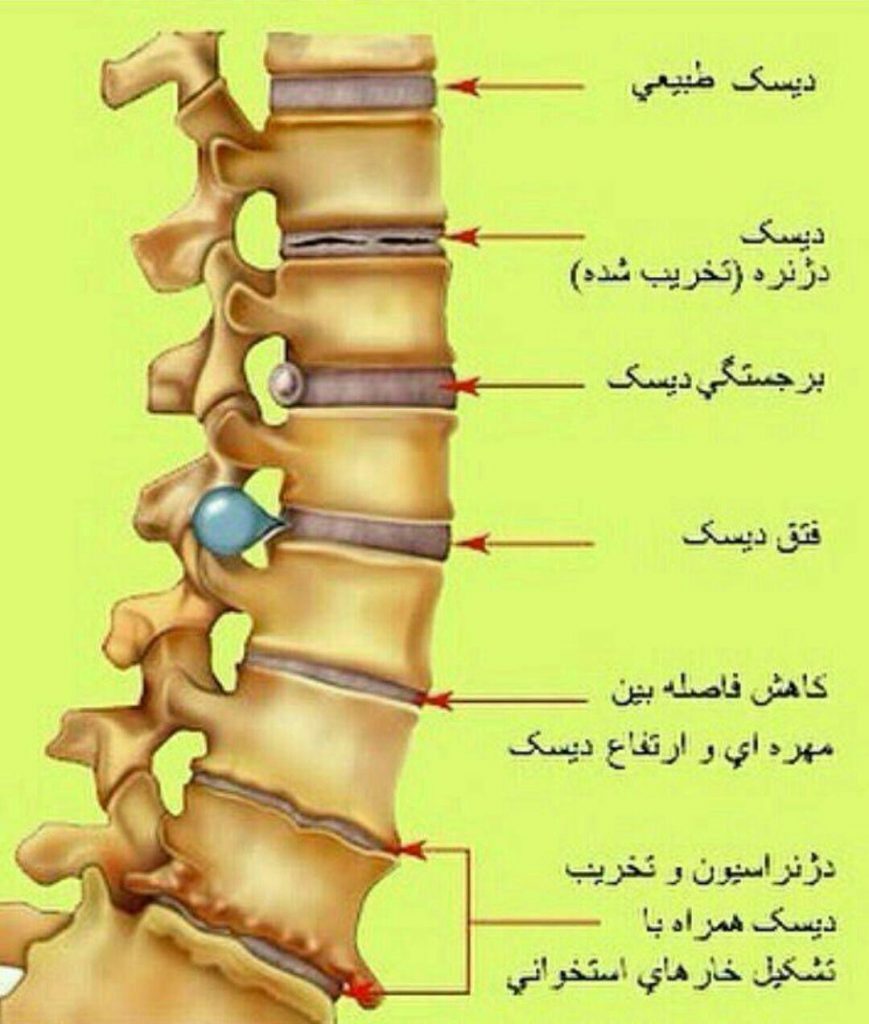 درمان دیسک کمر