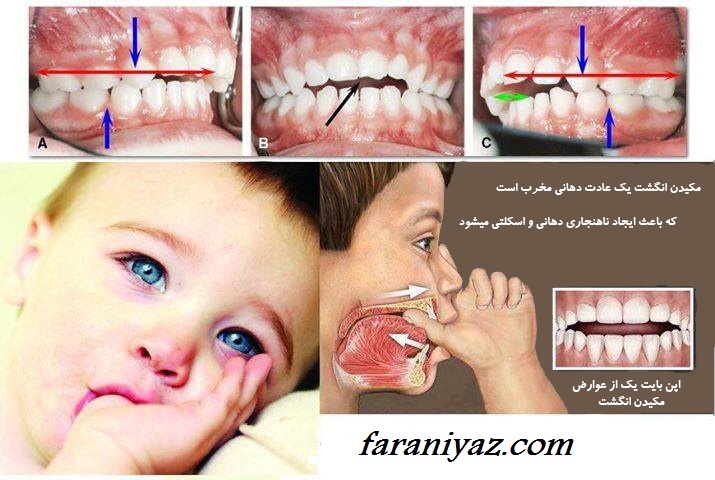 روشهای ترک مکیدن انگشت در کودکان