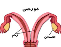 برخی زنان دو رحم دارند
