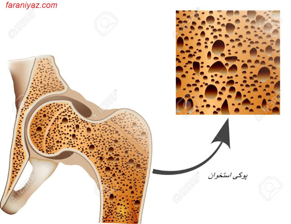 دلایل و درمان پوکی استخوان 