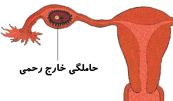 درمان حاملگی خارج از رحم با طب سنتی 