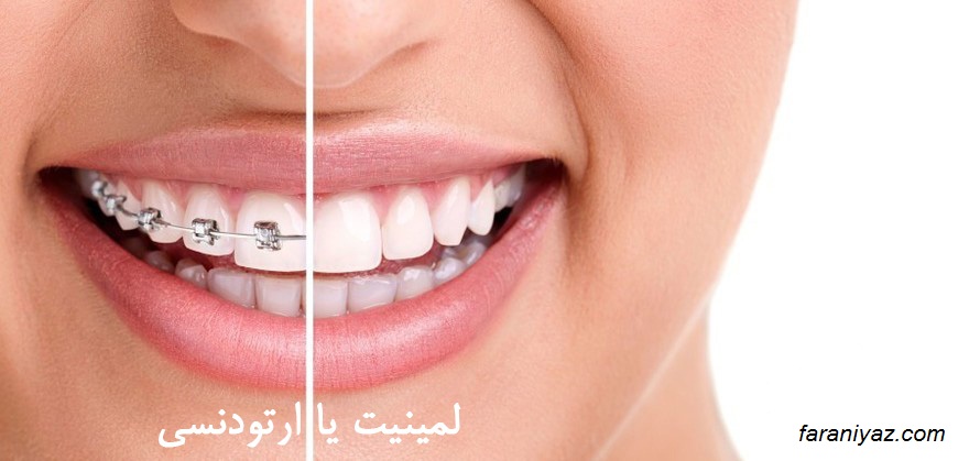 ارتودنسی یا کامپوزیت