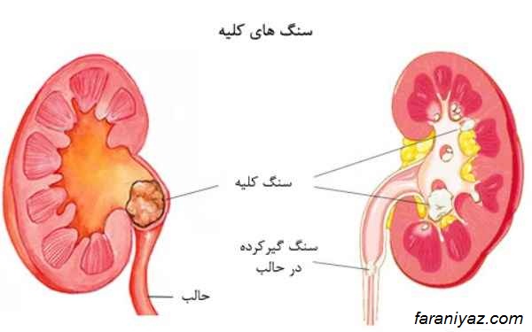 سنگ کلیه و روش های درمان ان