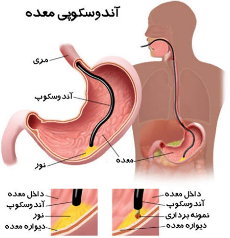 درمان قطعی ناراحتی معده بدون دارو