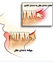 نکاتی برای کشیدن دندان عقل