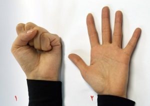 تپل شدن انگشتان دست