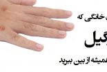 درمانهای خانگی زگیل